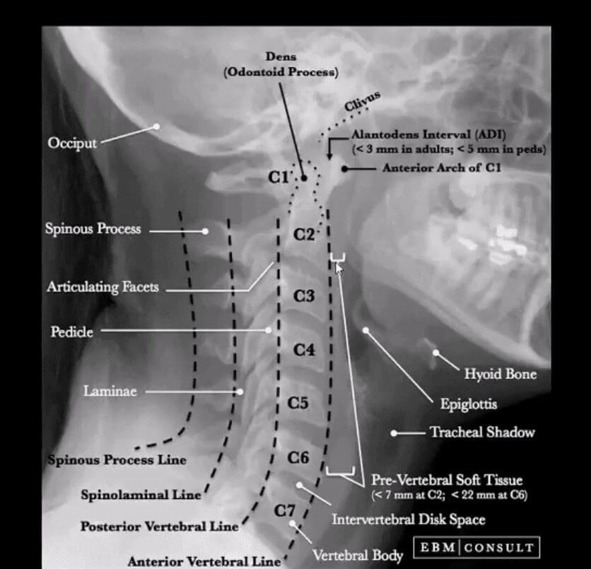 spinal trauma el paso tx.