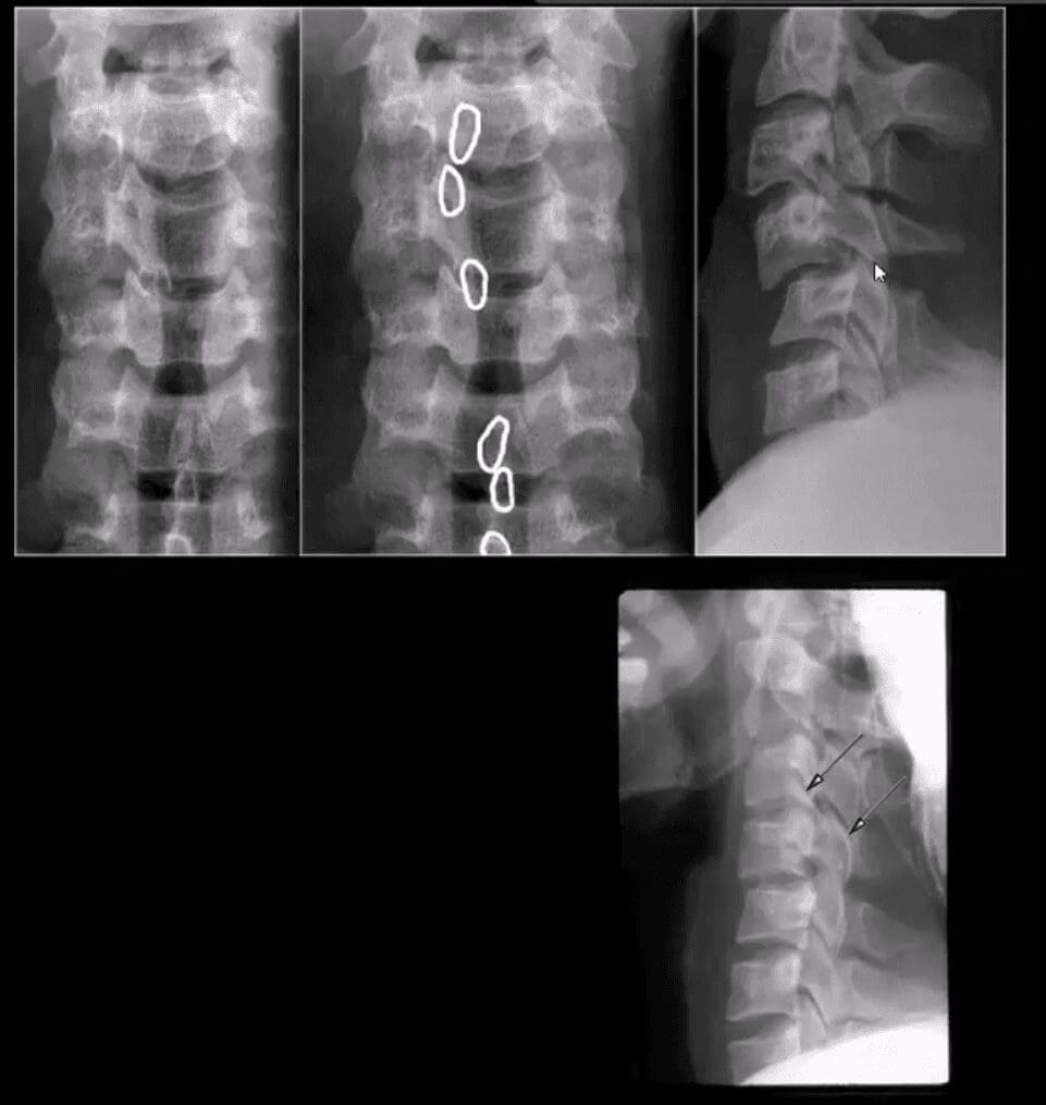 spinal trauma el paso tx.