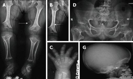 Achondroplasia Clinical Presentation | El Paso, TX Chiropractor