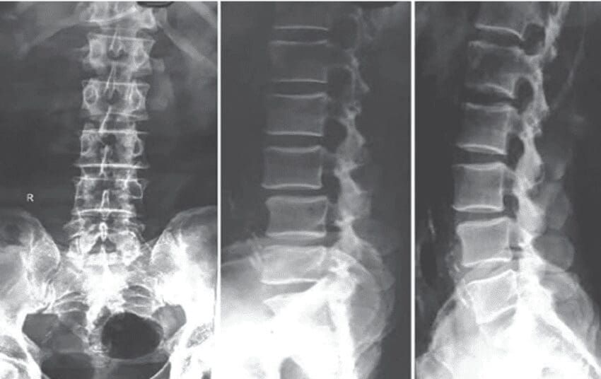 Classifying Spondylolisthesis | El Paso, TX Chiropractor