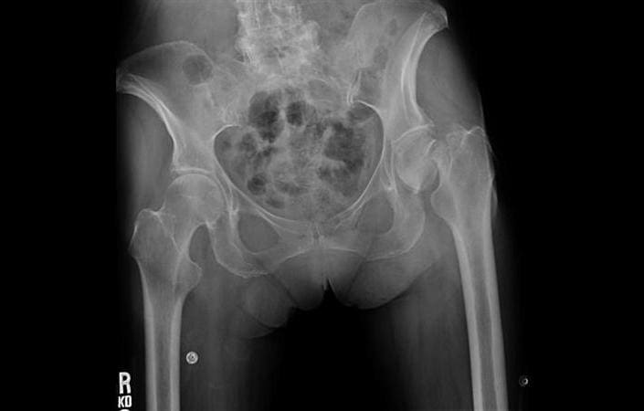 Impacted Femoral Neck Fractures | El Paso, TX Chiropractor