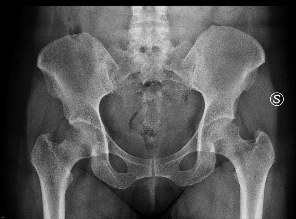 Osteitis Pubis Treatment | El Paso, TX Chiropractor