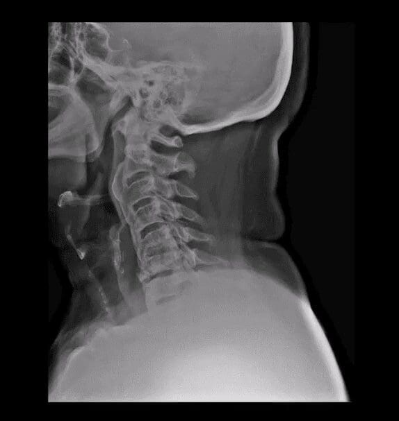 spinal arthritis el paso tx.