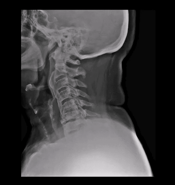 spinal arthritis el paso tx.