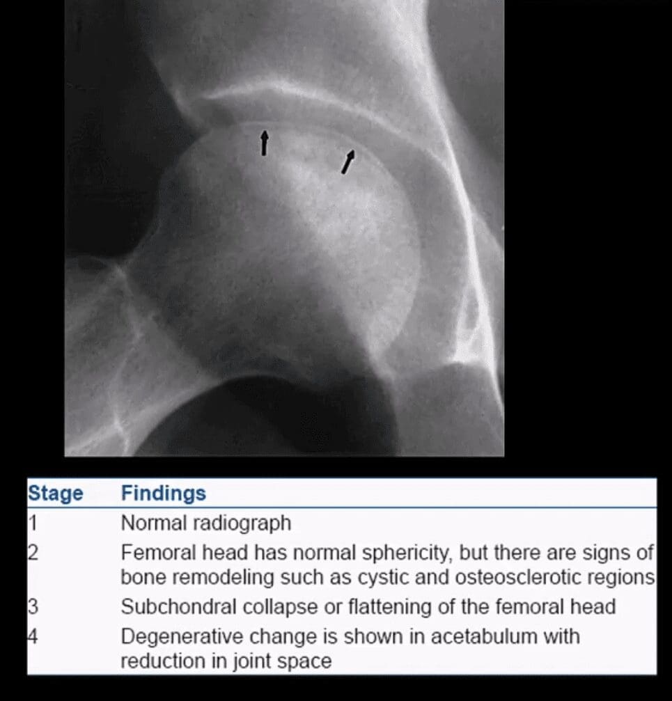 diagnosis hip arthritis and neoplasms el paso, tx.