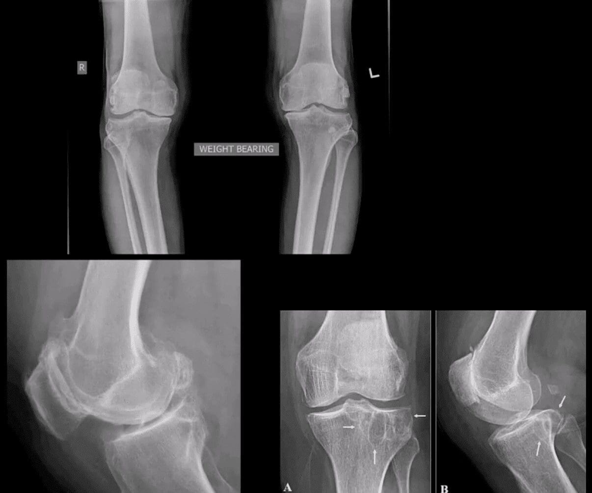 knee arthritis chiropractic care el paso tx.