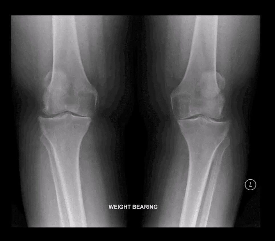 knee arthritis chiropractic care el paso tx.