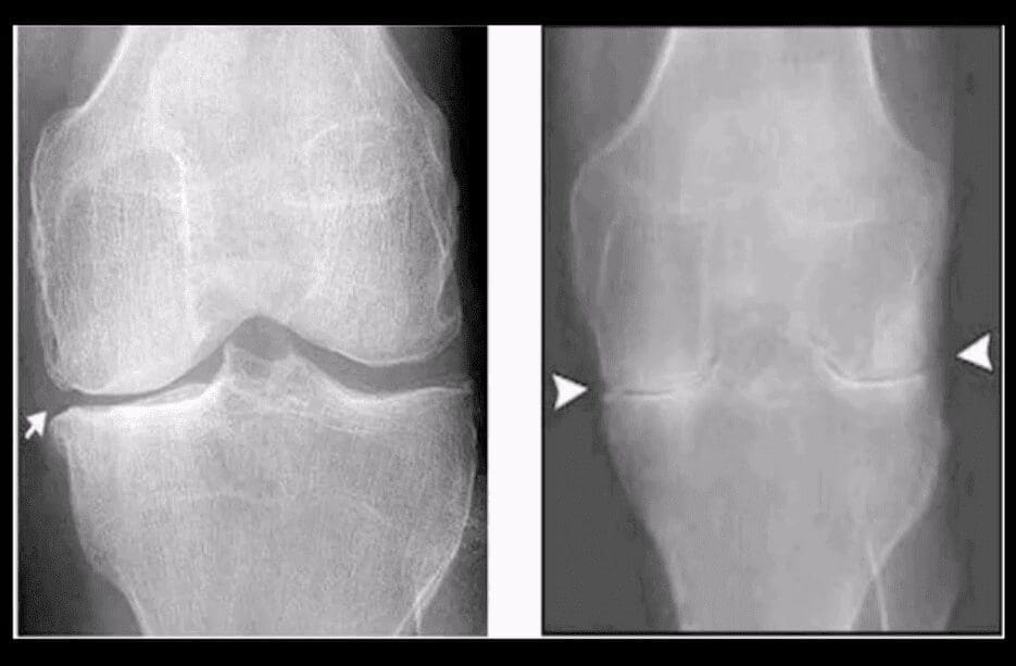 knee arthritis chiropractic care el paso tx.