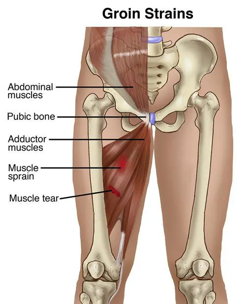 Groin Pain Causes Workers to Change Work Habits