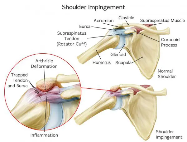 Swimmer's Shoulder: A Comprehensive Guide