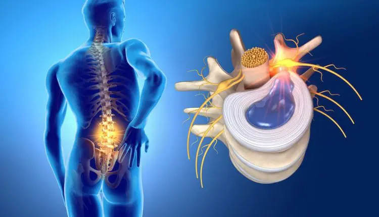 Herniated Disc Without Fusion: Alternative Approaches