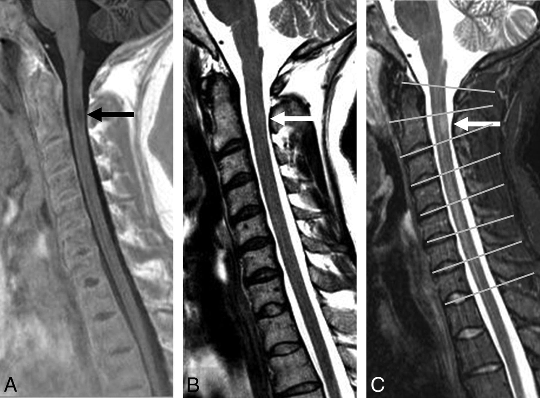T1 vs t2 vs stir image MRI spine