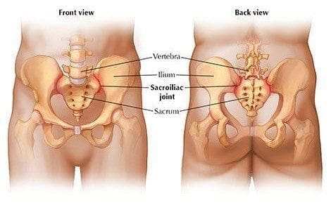 Blog Image  Treating Sacroiliac Diagram