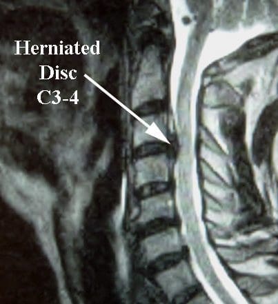 HerniatedDiscMRI ElPasoChiropractor