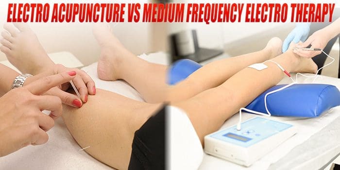 electroacupuncture