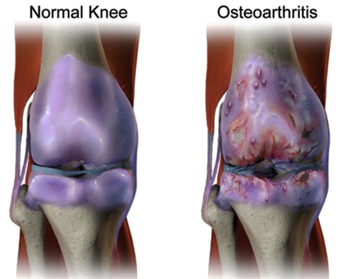 facetogenic neuropathic, osteoarthritis and headaches pain el paso tx.