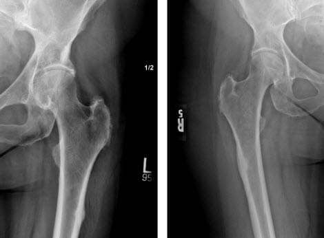 Bisphosphonate-Related Proximal Femoral Fractures | El Paso, TX Chiropractor