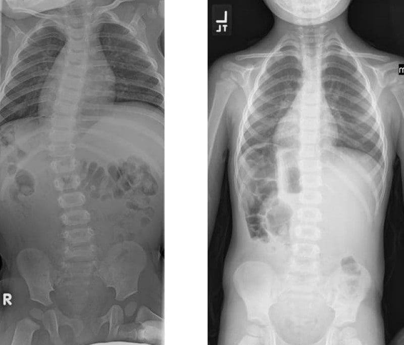 Scoliosis Clinical Presentation | El Paso, TX Chiropractor