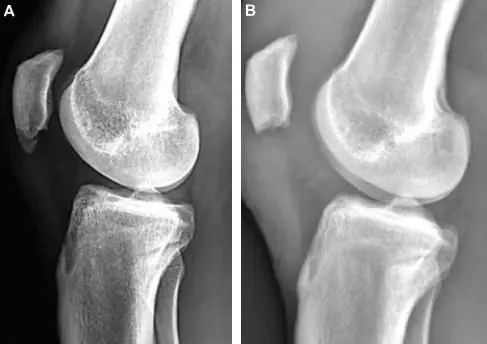 What Is Sinding-Larsen-Johansson Syndrome? | El Paso, TX Chiropractor