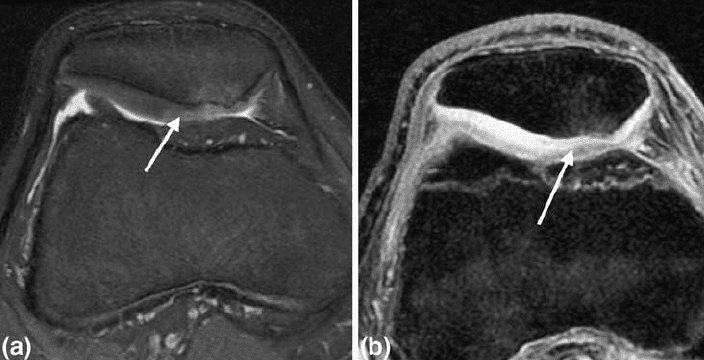 What is Chondromalacia Patellae? | El Paso, TX Chiropractor