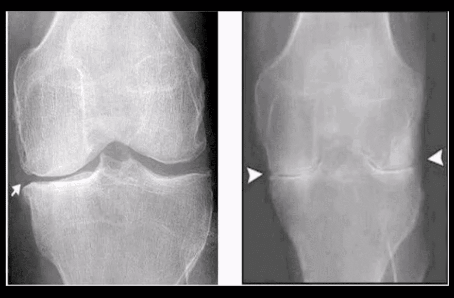 knee arthritis chiropractic care el paso tx.