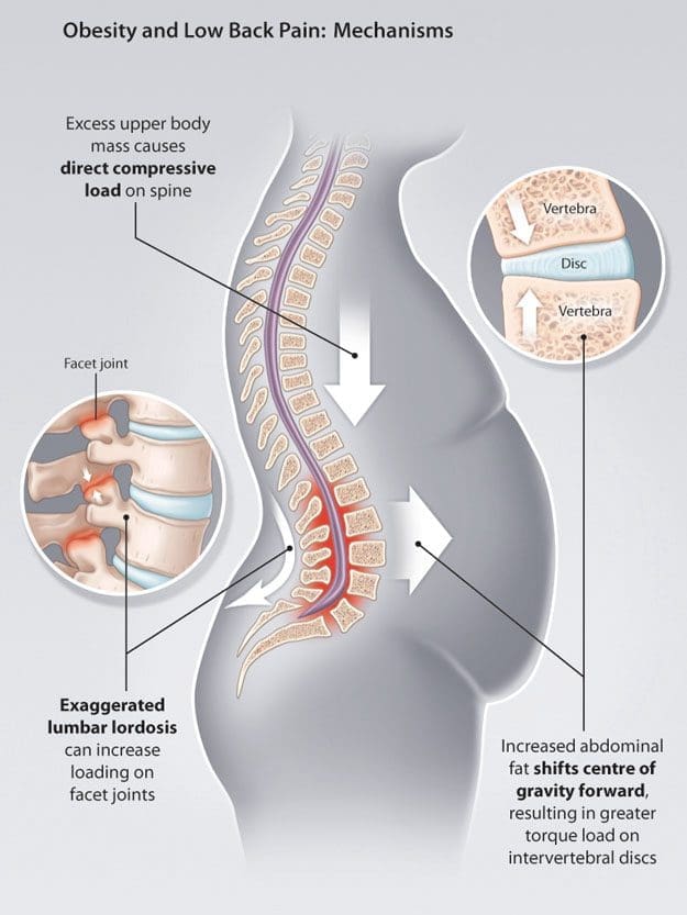 The Impact of Obesity Pressure on Herniated Discs and Back Pain