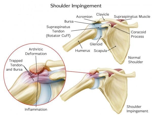 Swimmer's Shoulder: A Comprehensive Guide