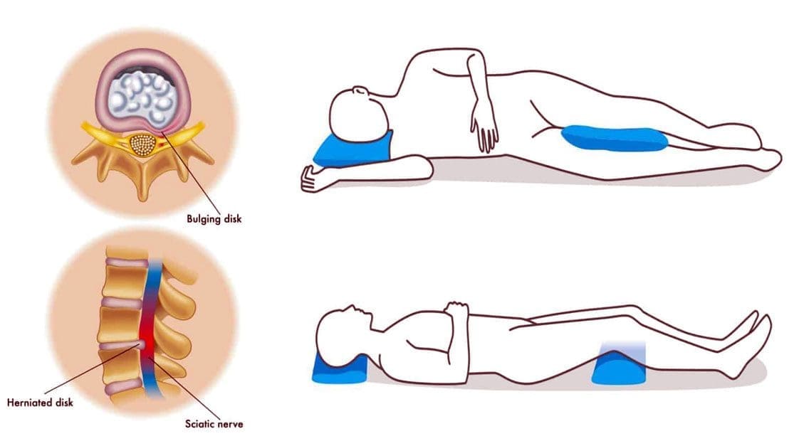 Relieve Back and Hip Pain with a Pillow Between the Legs