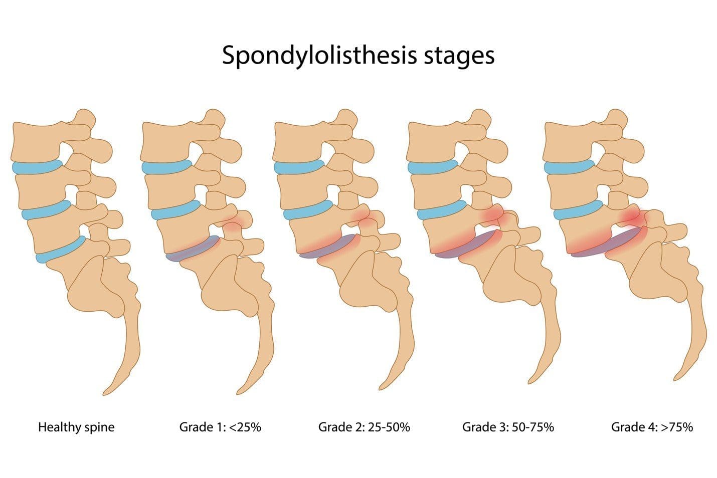 Everything You Need to Know about Anterolisthesis