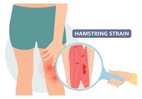 Understanding Hamstring Pain Behind the Knee