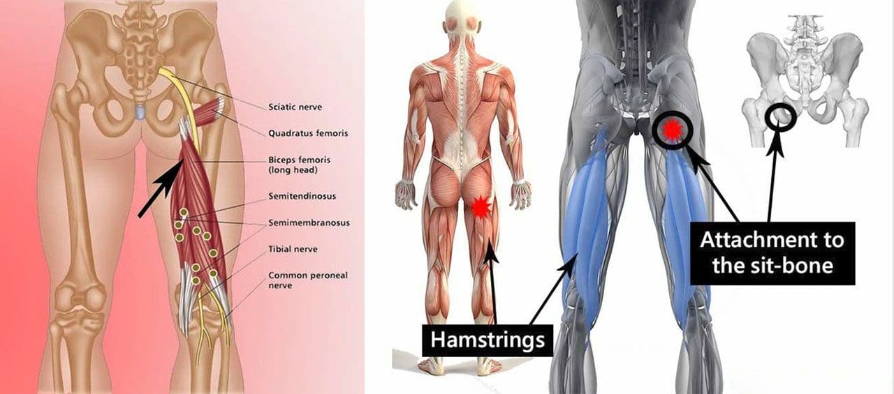 High Hamstring Tendinopathy: EP's Chiropractic Team