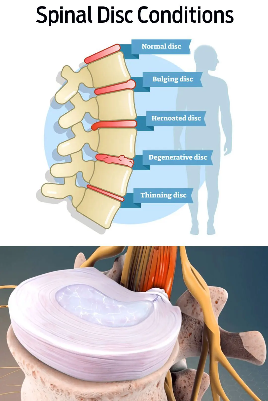 Facts About Bulging Disc Pain You Should Know
