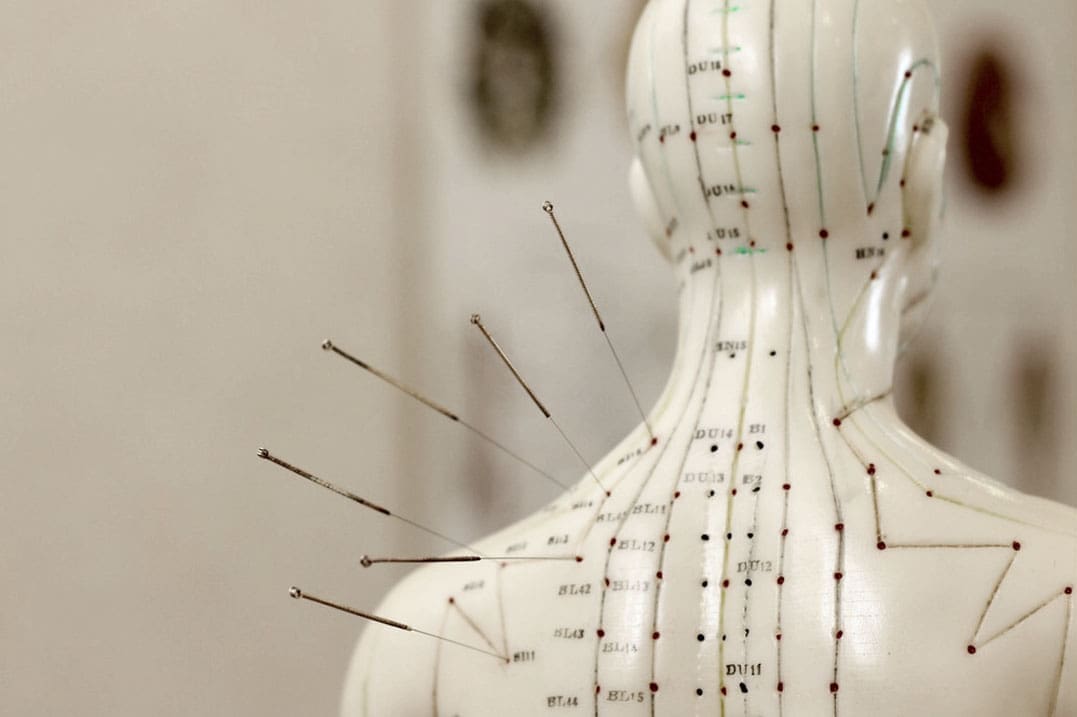 Acupuncture for Insomnia: A Holistic Approach to Better Sleep