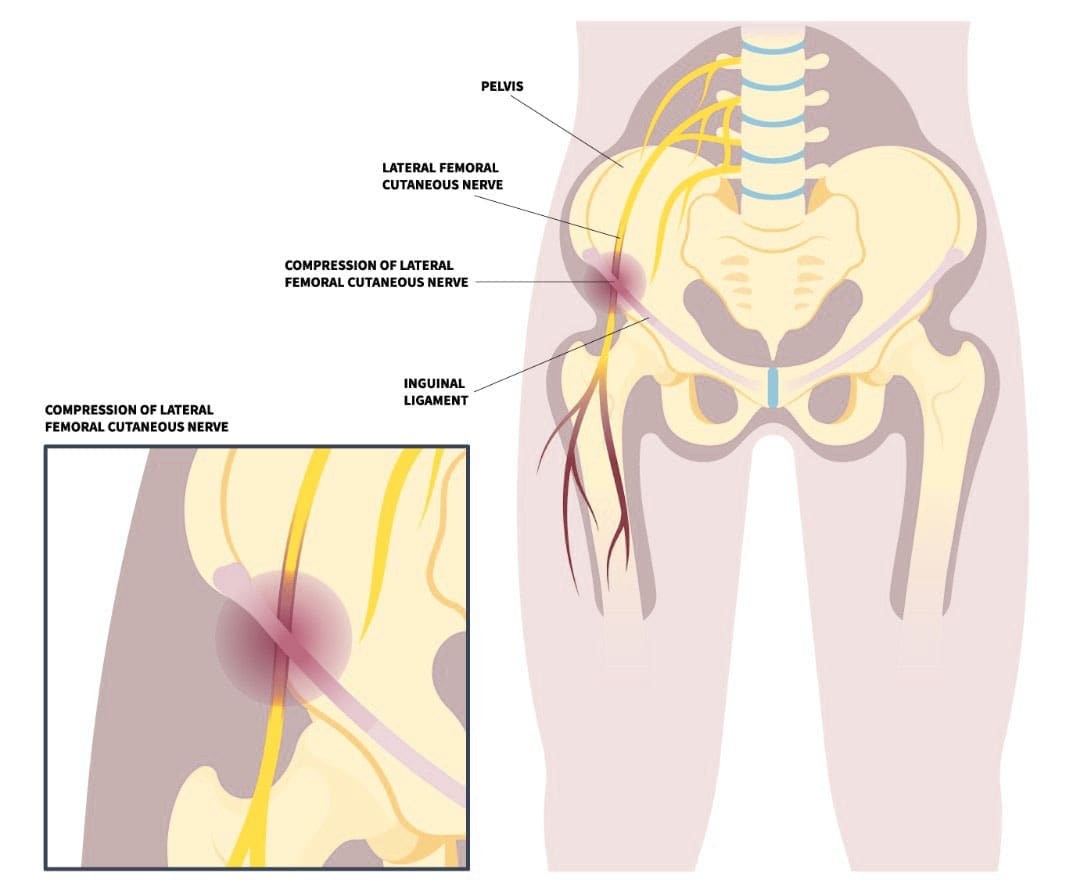 Relief from Meralgia Paresthetica: Tips and Treatment Options